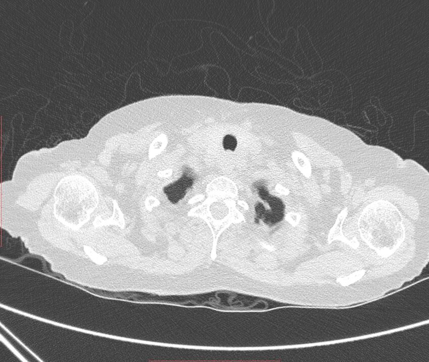 Bronchiectasis (Radiopaedia 72693-83293 Axial lung window 1).jpg