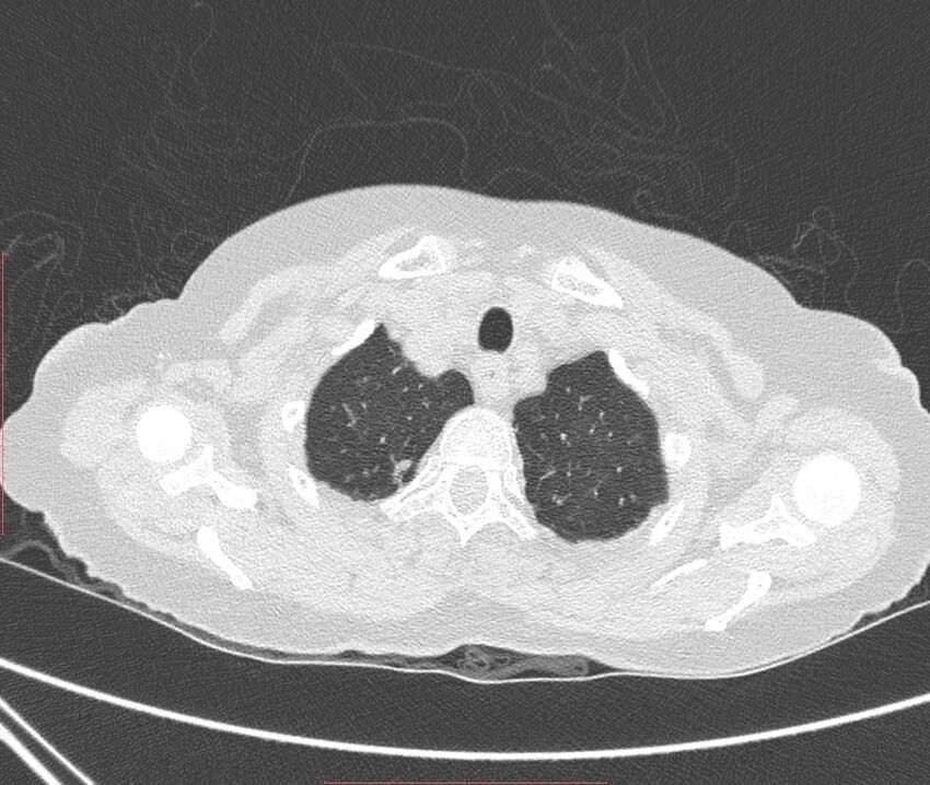Bronchiectasis (Radiopaedia 72693-83293 Axial lung window 9).jpg