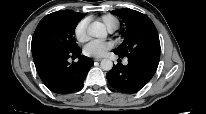 File:Bronchogenic carcinoma with superior vena cava syndrome (Radiopaedia 36497-38054 Axial C+ delayed 58).jpg