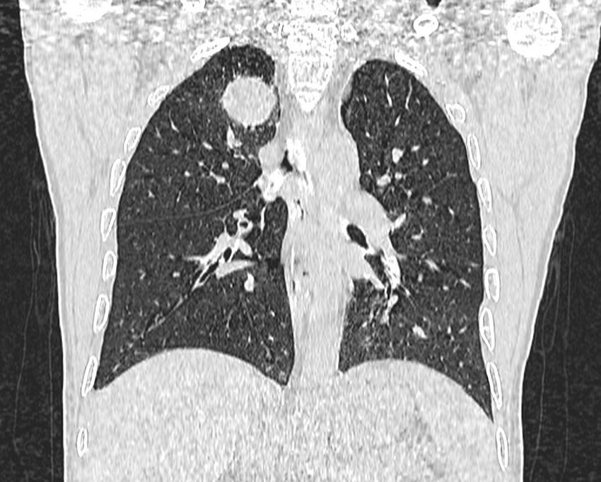 Bronchogenic carcinoma with superior vena cava syndrome (Radiopaedia 36497-38054 Coronal lung window 57).jpg