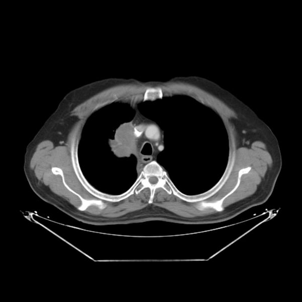 File:Bronchogenic carcinoma with upper lobe collapse (Radiopaedia 29297-29726 C 10).jpg