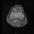 Bucket handle tear - lateral meniscus (Radiopaedia 72124-82634 Axial PD fat sat 4).jpg