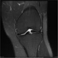 Bucket handle tear - lateral meniscus (Radiopaedia 7246-8187 Coronal T2 fat sat 13).jpg