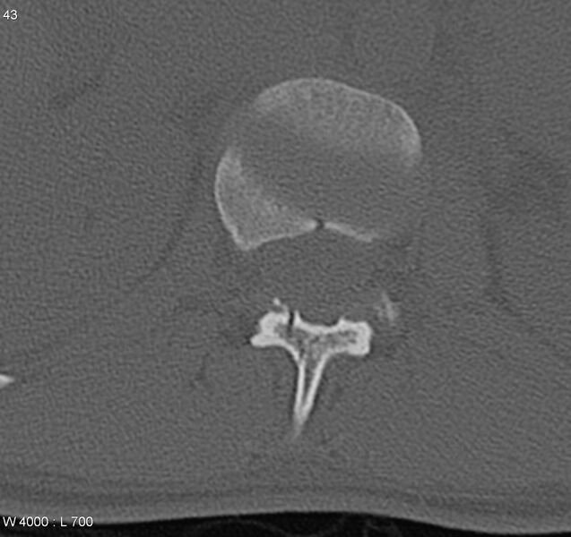 File:Burst fracture (Radiopaedia 5274-7018 Axial bone window 9).jpg
