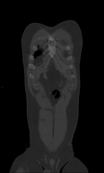 File:Burst fracture (Radiopaedia 83168-97542 Coronal bone window 13).jpg