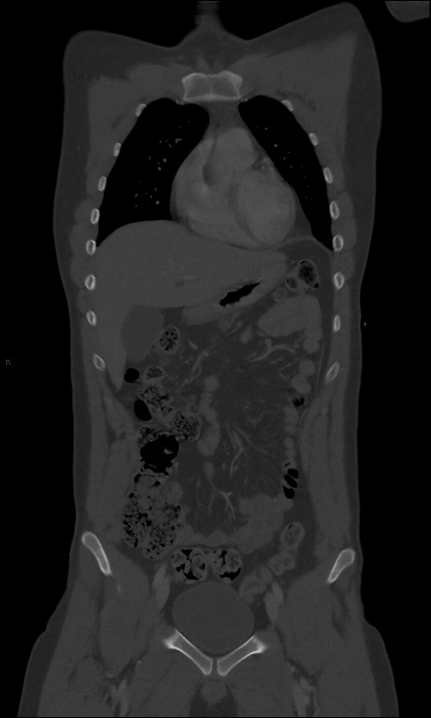 Burst fracture (Radiopaedia 83168-97542 Coronal bone window 24).jpg