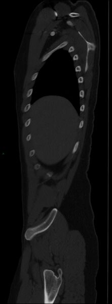 File:Burst fracture (Radiopaedia 83168-97542 Sagittal bone window 31).jpg