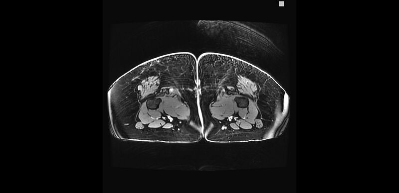 File:Buttock filler complications (Radiopaedia 63497-72115 Axial T1 C+ 62).jpg