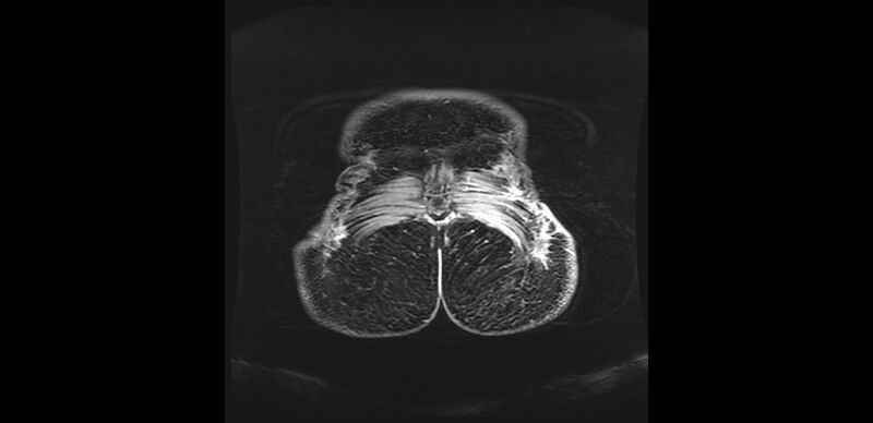 File:Buttock filler complications (Radiopaedia 63497-72115 Coronal T1 C+ 63).jpg