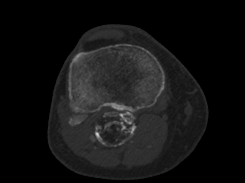 Calcified hematoma - popliteal fossa (Radiopaedia 63938-72763 C 51).jpg