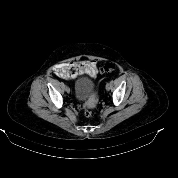 File:Calcified hydatid cyst (Radiopaedia 62000-70085 Axial non-contrast 94).jpg