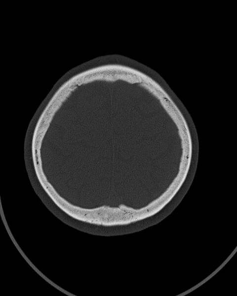 File:Calcified meningioma (Radiopaedia 74361-85243 Axial bone window 2).jpg