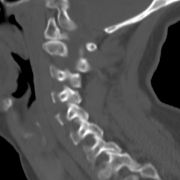 File:Calcified meningioma - cervical canal (Radiopaedia 70136-80171 Sagittal bone window 26).jpg