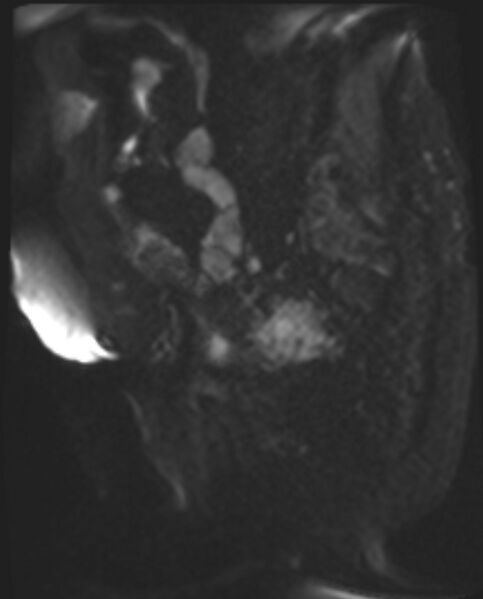 File:Cancer cervix - stage IIb (Radiopaedia 75411-86615 Sagittal DWI 29).jpg