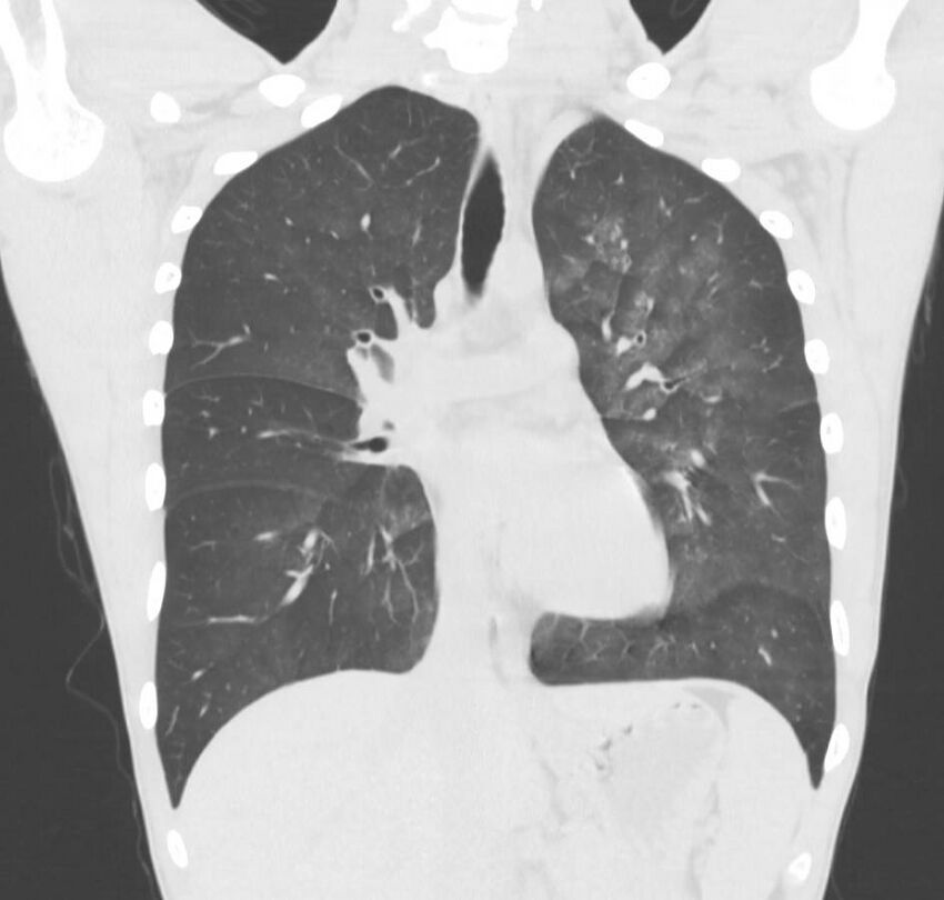 Cannabis-induced diffuse alveolar hemorrhage (Radiopaedia 89834-106946 Coronal lung window 49).jpg