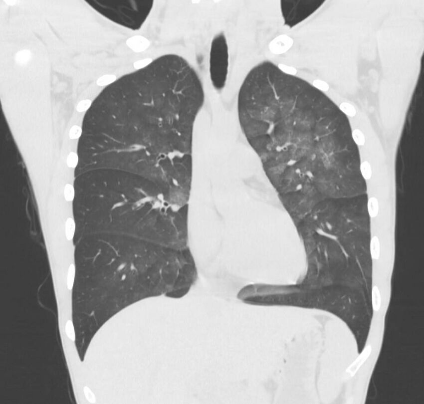 Cannabis-induced diffuse alveolar hemorrhage (Radiopaedia 89834-106946 Coronal lung window 55).jpg