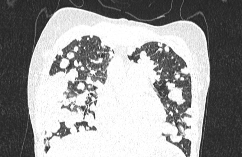 File:Cannonball metastases from breast cancer (Radiopaedia 91024-108569 Coronal lung window 45).jpg