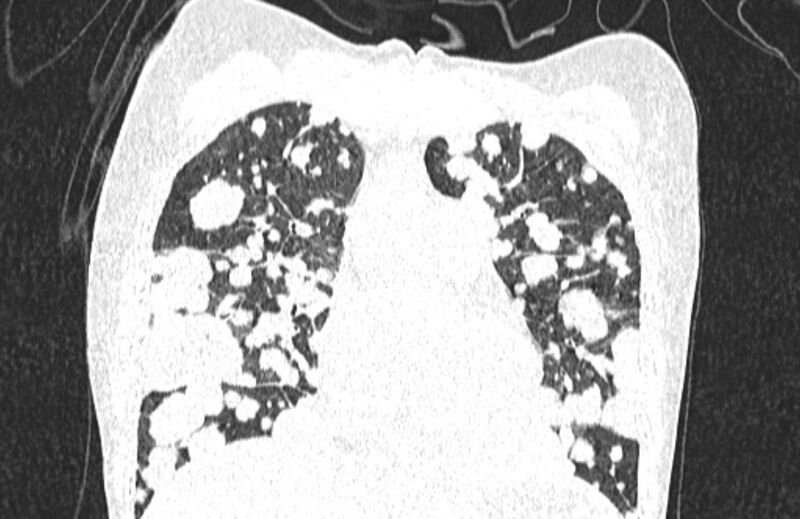 File:Cannonball metastases from breast cancer (Radiopaedia 91024-108569 Coronal lung window 52).jpg