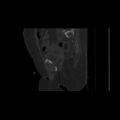 Carcinoma cervix- brachytherapy applicator (Radiopaedia 33135-34173 Sagittal bone window 63).jpg