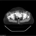 Carcinoma cervix- recurrence (Radiopaedia 34702-36137 B 88).jpg