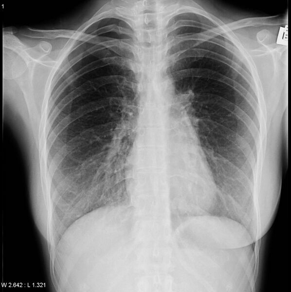 File:Catamenial pneumothorax (Radiopaedia 24847-25113 Frontal 1).jpg