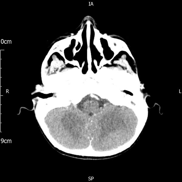 File:Cavernous sinus thrombosis (Radiopaedia 79414-92510 Axial Brain 62).jpg