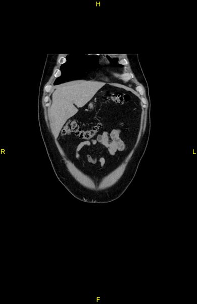 File:Cecal epiploic appendagitis (Radiopaedia 86047-102164 B 15).jpg