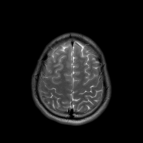 File:Central neurocytoma (Radiopaedia 79320-92380 Axial T2 23).jpg