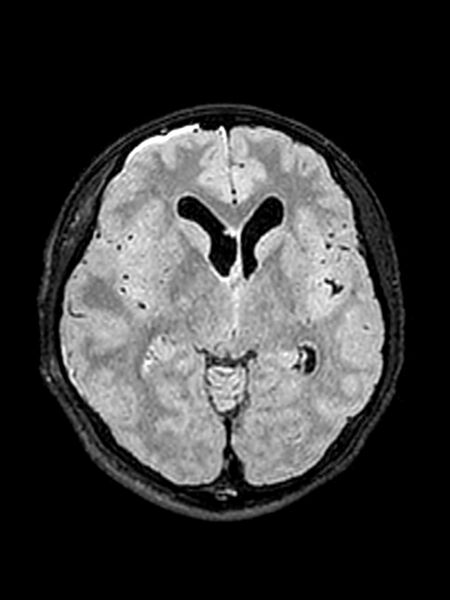 File:Central neurocytoma (Radiopaedia 79320-92381 Axial FLAIR 94).jpg