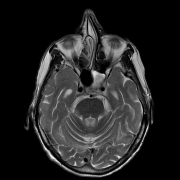 File:Cerebellar ataxia with neuropathy and vestibular areflexia syndrome (CANVAS) (Radiopaedia 74283-85159 Axial T2 8).jpg