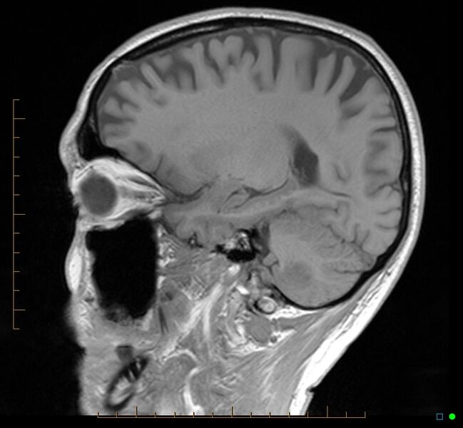 File:Cerebellar gangliocytoma (Radiopaedia 65377-74422 Sagittal T1 14).jpg