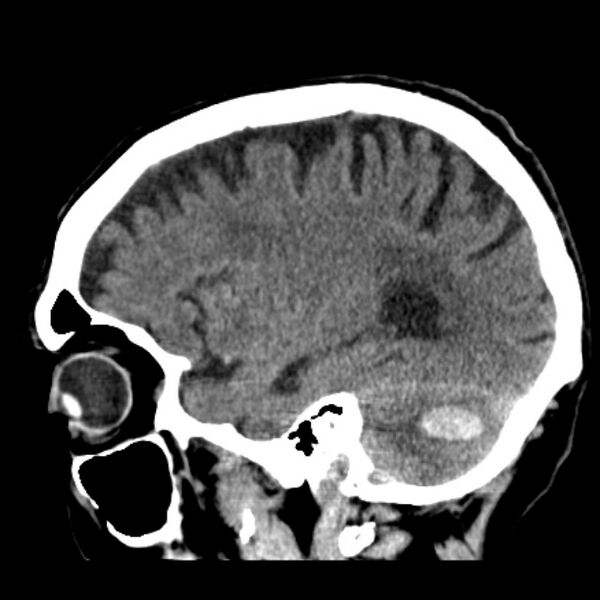 File:Cerebellar hemorrhage (Radiopaedia 27193-27359 C 32).jpg