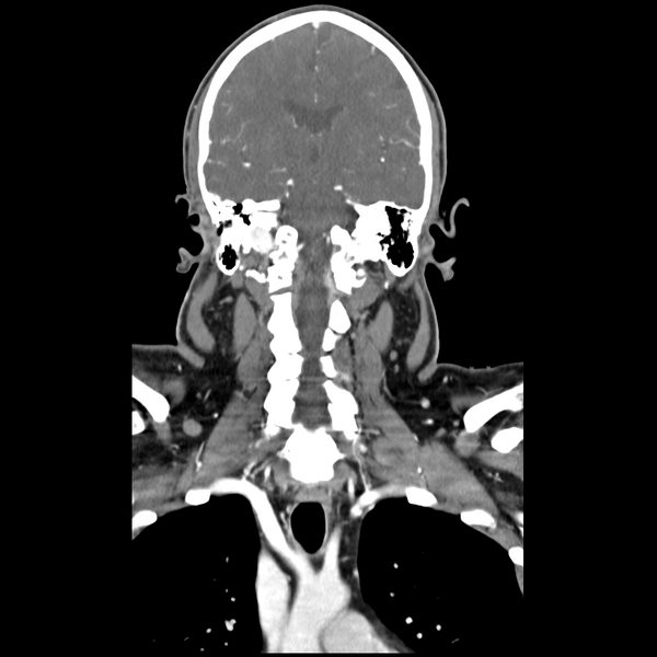 File:Cerebellar infarct due to vertebral artery dissection with posterior fossa decompression (Radiopaedia 82779-97029 D 34).png