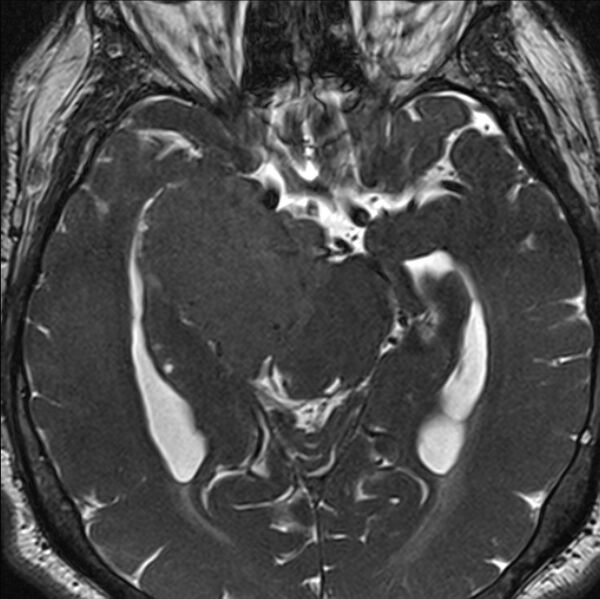 File:Cerebellopontine angle meningioma (Radiopaedia 24459-24764 I 40).jpg