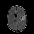 Cerebral abscess post cardiac surgery (Radiopaedia 27244-27420 Axial FLAIR 15).jpg