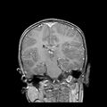 Cerebral abscess post cardiac surgery (Radiopaedia 27244-27420 Coronal T1 C+ 13).jpg