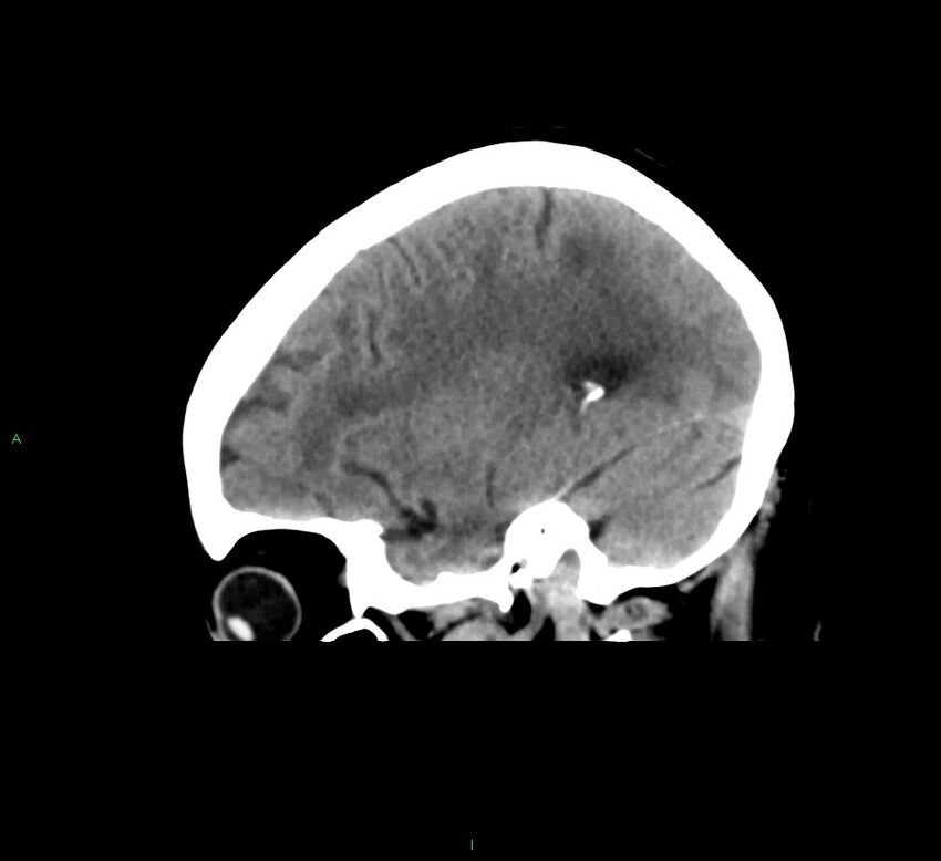 Cerebral amyloid angiopathy-associated lobar intracerebral hemorrhage (Radiopaedia 58378-65516 C 36).jpg