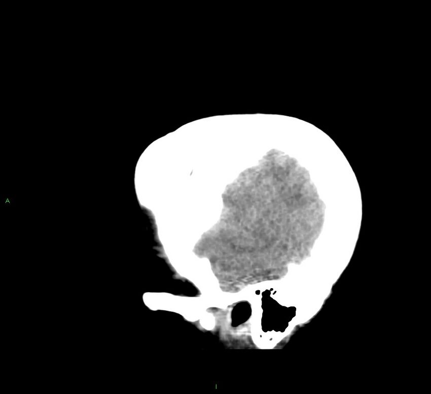 Cerebral amyloid angiopathy-associated lobar intracerebral hemorrhage (Radiopaedia 58379-65519 C 7).jpg