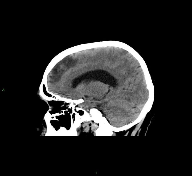 File:Cerebral amyloid angiopathy-associated lobar intracerebral hemorrhage (Radiopaedia 58529-65681 B 20).jpg