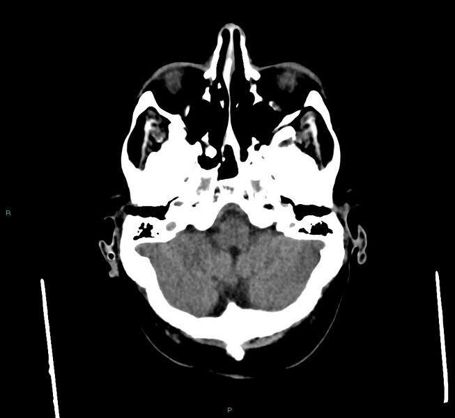 File:Cerebral amyloid angiopathy-associated lobar intracerebral hemorrhage (Radiopaedia 58560-65723 Axial non-contrast 43).jpg