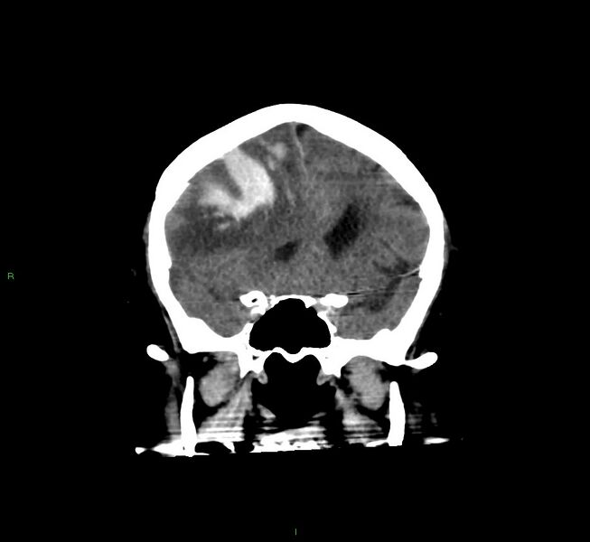 File:Cerebral amyloid angiopathy-associated lobar intracerebral hemorrhage (Radiopaedia 58560-65723 Coronal non-contrast 47).jpg