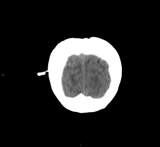 File:Cerebral amyloid angiopathy-associated lobar intracerebral hemorrhage (Radiopaedia 58566-65730 Coronal non-contrast 10).jpg