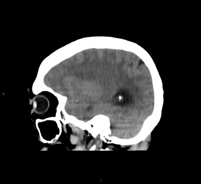 File:Cerebral amyloid angiopathy-associated lobar intracerebral hemorrhage (Radiopaedia 58751-65972 C 39).jpg