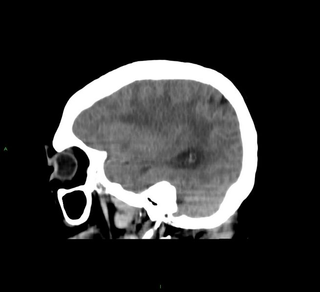 File:Cerebral amyloid angiopathy-associated lobar intracerebral hemorrhage (Radiopaedia 58751-65972 C 40).jpg