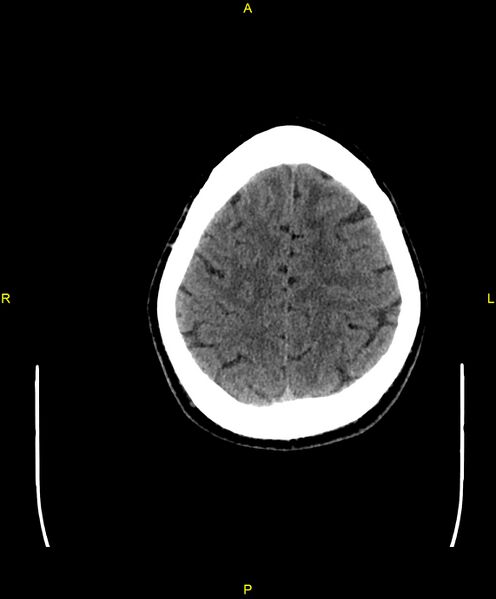 File:Cerebral autosomal dominant arteriopathy with subcortical infarcts and leukoencephalopathy (CADASIL) (Radiopaedia 86108-102051 Axial non-contrast 92).jpg