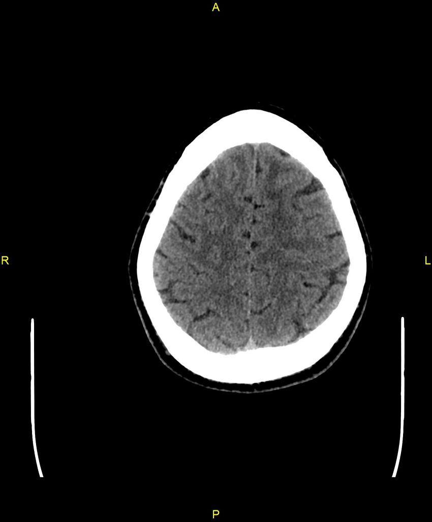 Cerebral autosomal dominant arteriopathy with subcortical infarcts and leukoencephalopathy (CADASIL) (Radiopaedia 86108-102051 Axial non-contrast 92).jpg