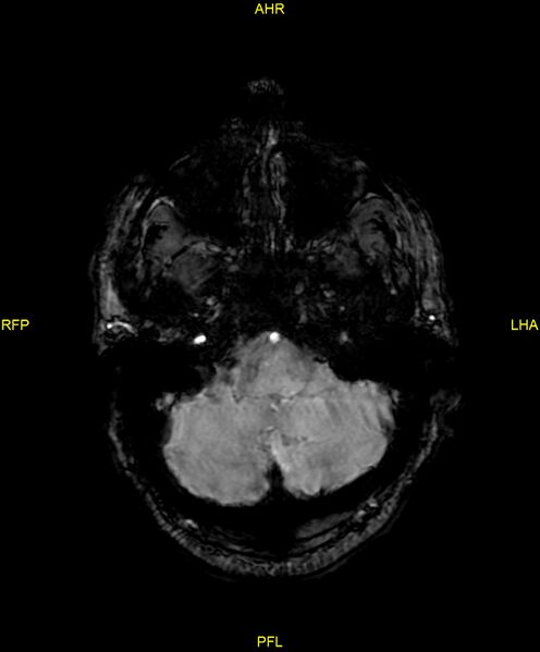 File:Cerebral autosomal dominant arteriopathy with subcortical infarcts and leukoencephalopathy (CADASIL) (Radiopaedia 86108-102054 Axial SWI 23).jpg