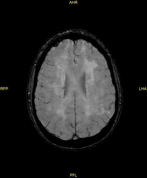 File:Cerebral autosomal dominant arteriopathy with subcortical infarcts and leukoencephalopathy (CADASIL) (Radiopaedia 86108-102054 Axial SWI 72).jpg
