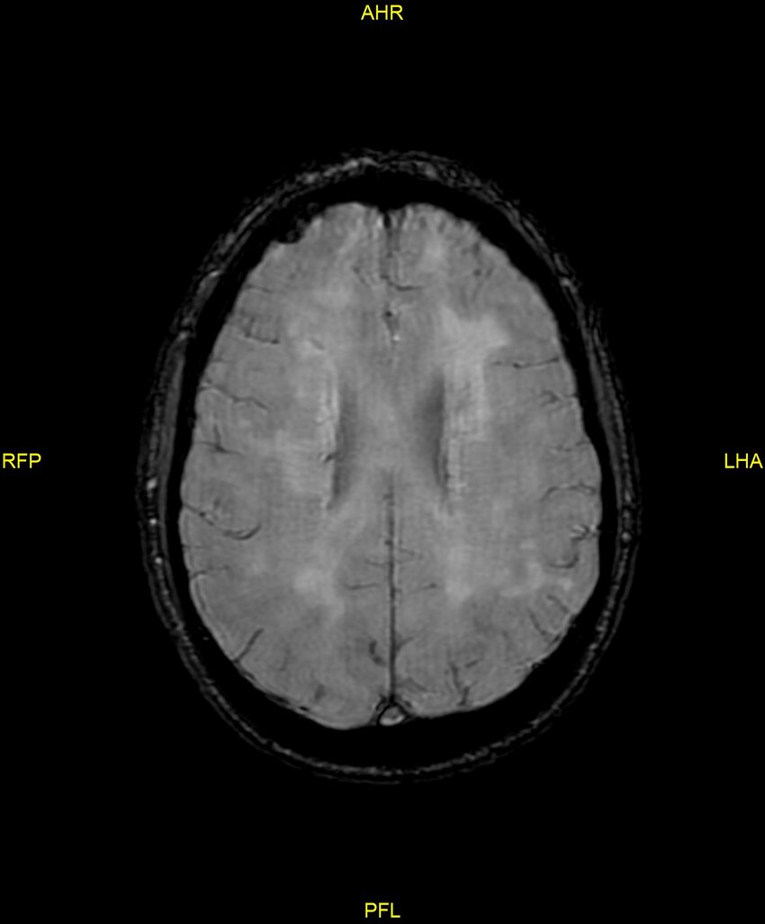 Cerebral autosomal dominant arteriopathy with subcortical infarcts and leukoencephalopathy (CADASIL) (Radiopaedia 86108-102054 Axial SWI 72).jpg