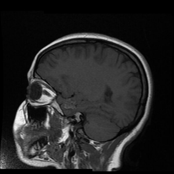 File:Cerebral cavernous malformation (Radiopaedia 44301-47942 Sagittal T1 6).jpg